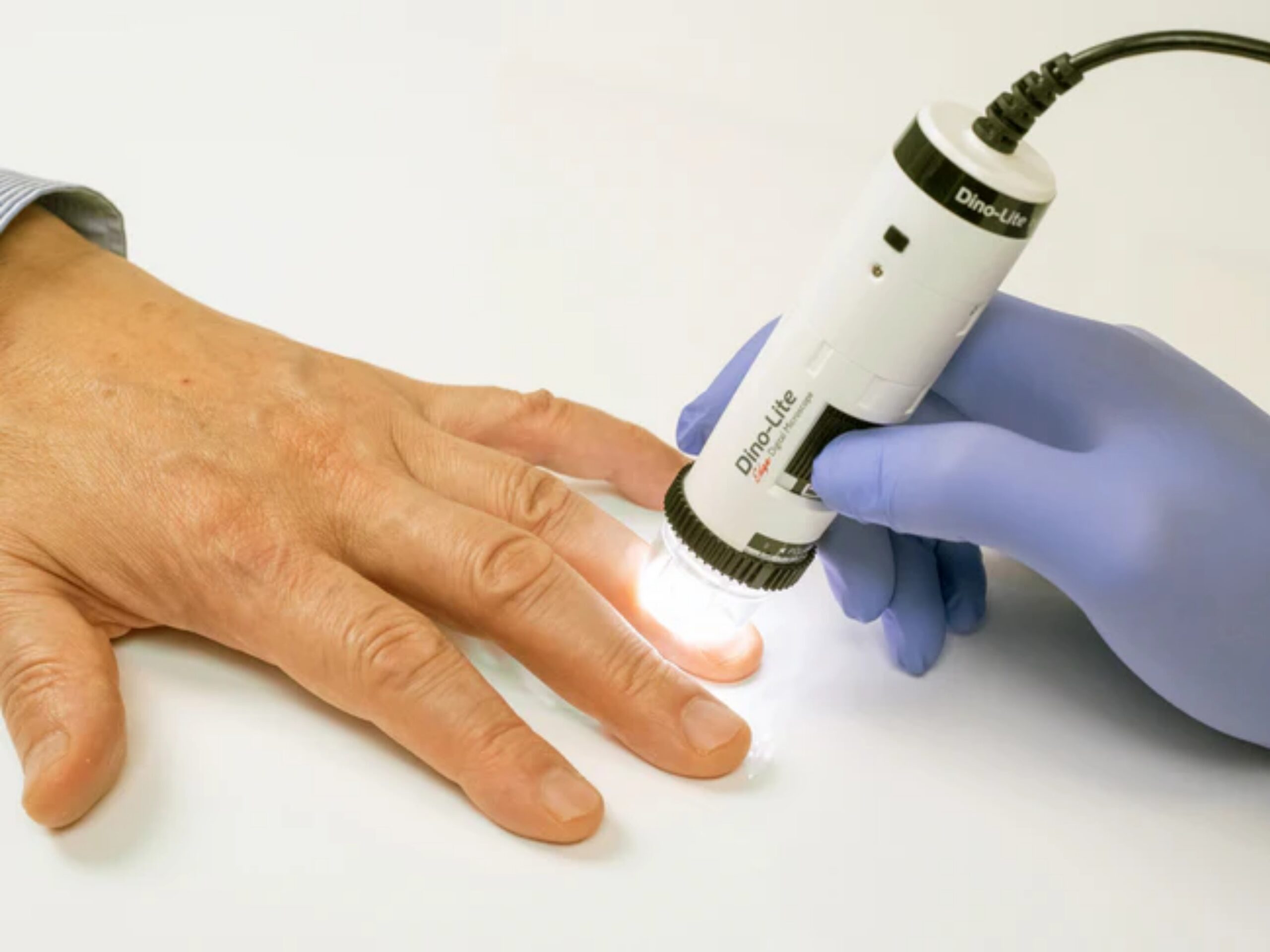 Análisis microvascular